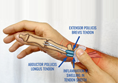 de Quervain's Tenosynovitis